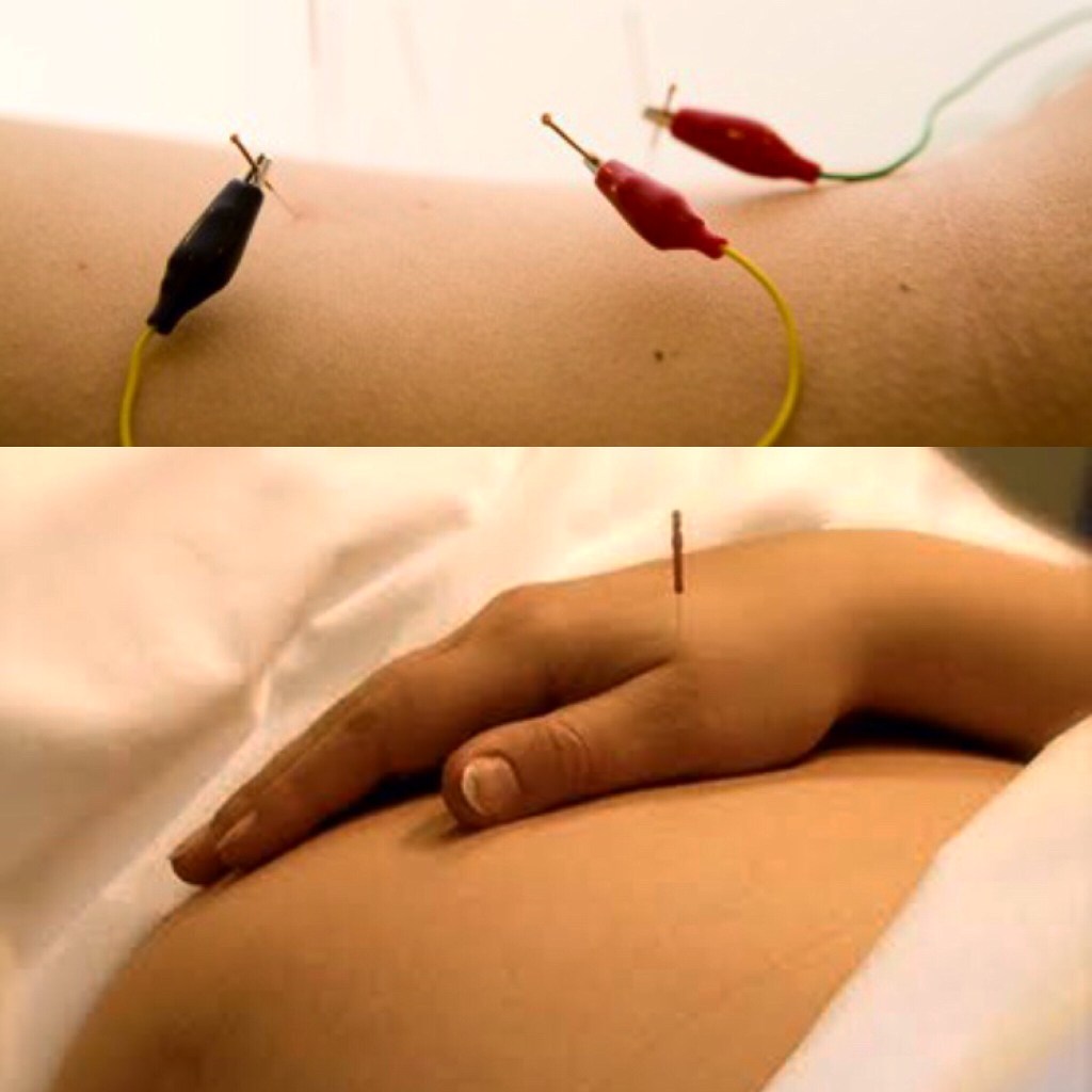 Os Benefícios da Acupuntura no Parto Natural