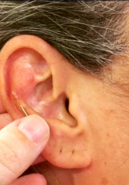 Acupuntura Auricular – Cuidados com os Tamanhos de Agulhas!