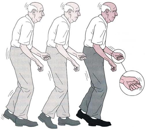 ENTENDENDO O PARKINSON SEGUNDO A MEDICINA TRADICIONAL&nbsp;CHINESA