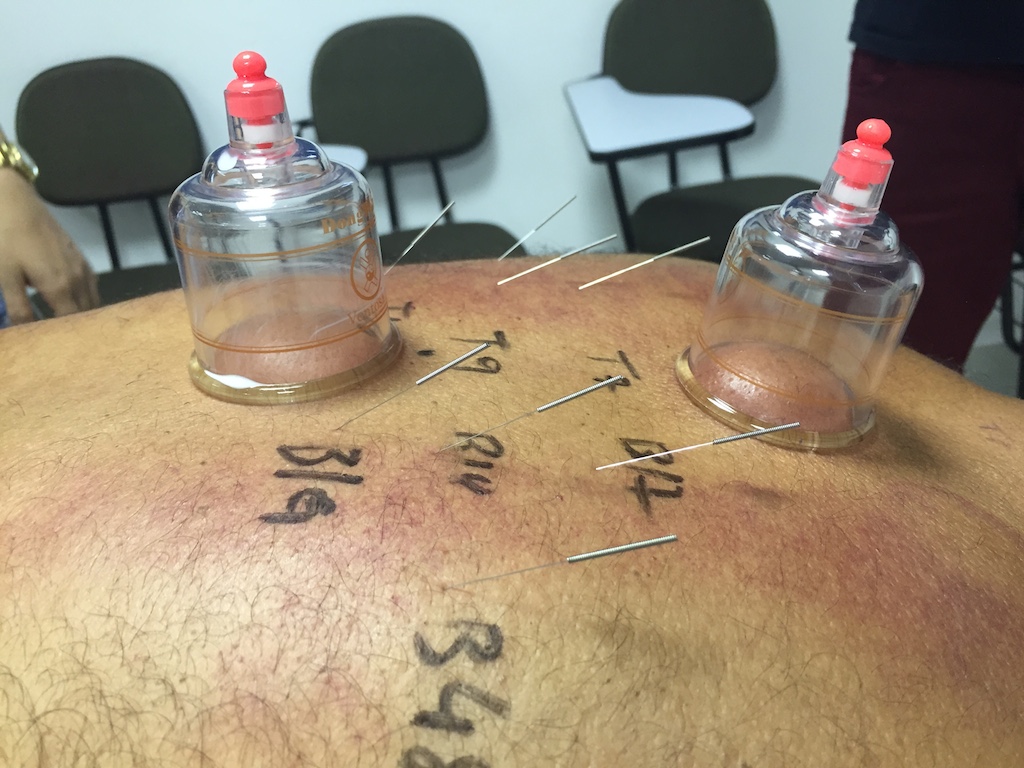 AS VÁRIAS AVALIAÇÕES da MEDICINA CHINESA: VENTOSA