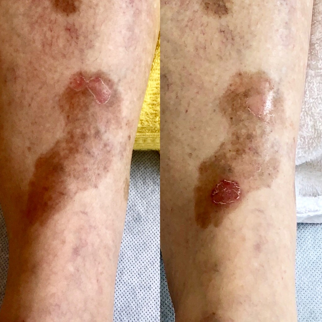 Psoríase Segundo a Medicina Tradicional&nbsp;Chinesa