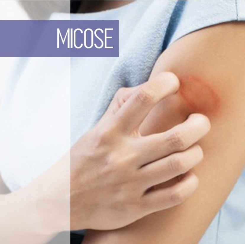 Como curar Micose utilizando&nbsp;Moxa